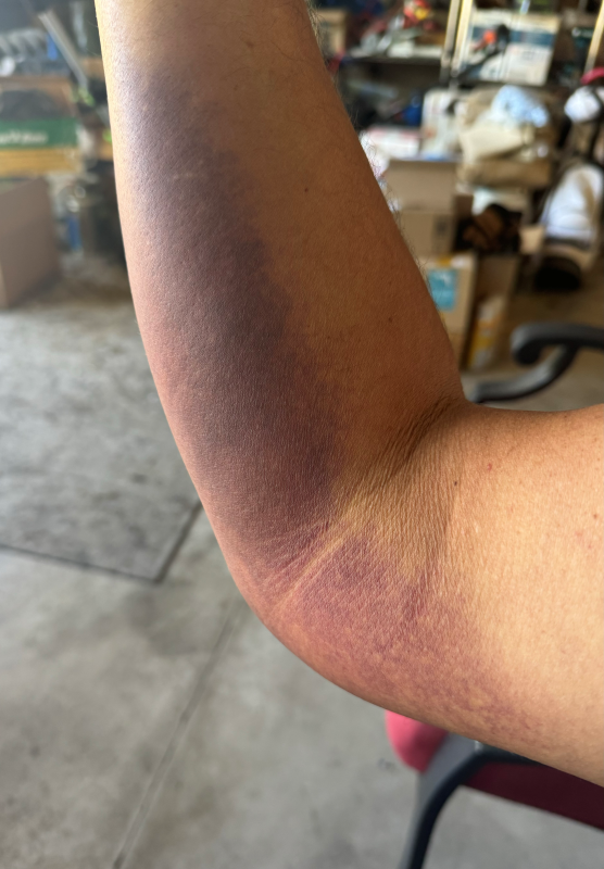 Torn Triceps working in that yard 